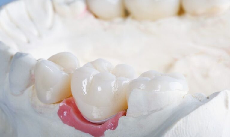 Dental Crowns Boerne