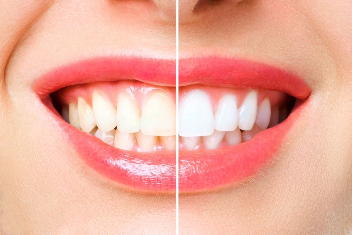 store-bought-teeth-whitening